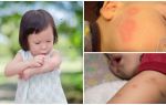 Muỗi cắn trên da của người lớn hoặc trẻ em
