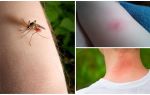 Sự khác biệt giữa muỗi cắn và bọ hoặc bọ chét là gì?