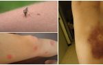 Tại sao vết bầm tím vẫn còn sau khi bị muỗi cắn?