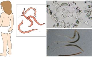 Pinworms là gì và chúng trông như thế nào