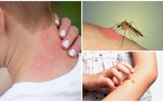 Tại sao muỗi cắn ngứa