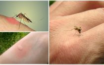 Tại sao muỗi cắn một số người nhiều hơn những người khác