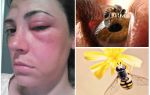 Điều gì nếu một con ong cắn vào mắt và nó sưng lên