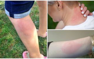 Điều trị dị ứng với muỗi đốt ở người lớn và trẻ em