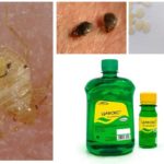 Cyclox khắc phục cho bedbugs