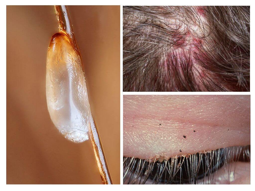 Nguy hiểm của pediculosis