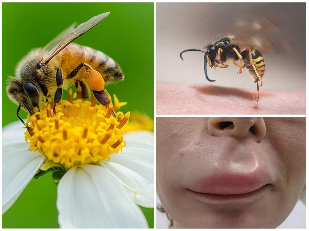 Bee chích trong môi