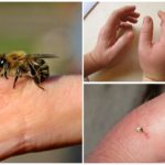 Tác hại từ ong sting