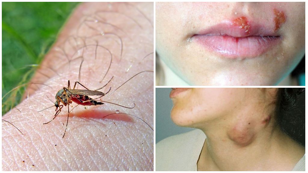 Sốt rét và bệnh sốt rét cho muỗi