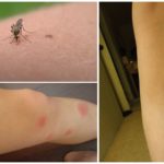 Muỗi cắn vết thâm tím