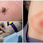 Xét nghiệm máu đối với bệnh vẩy nến sau khi bị bọ chét cắn