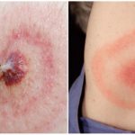 Bệnh Lyme hoặc Borreliosis do Tick-borne