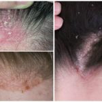 Demodecosis của da đầu