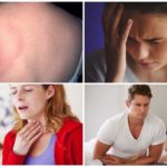 Các triệu chứng của bệnh vẩy nến